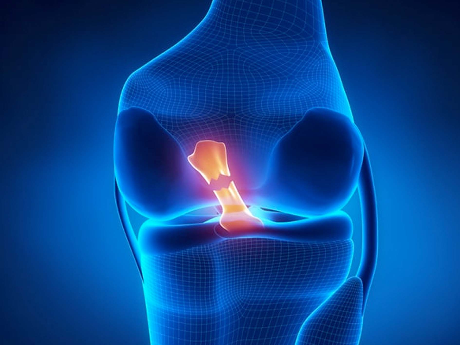 Knackpunkt Kreuzbandriss